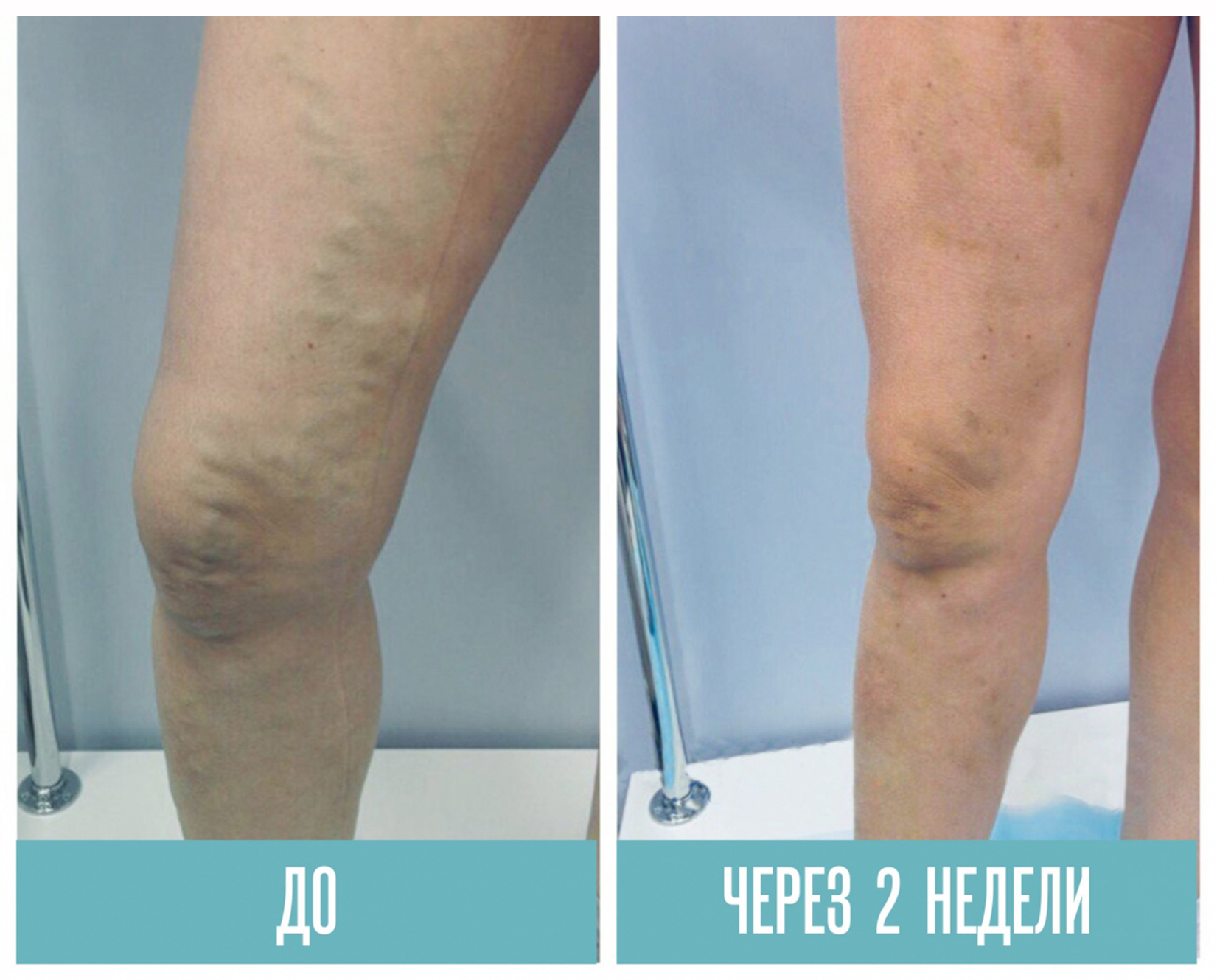 tratai peroxidul de hidrogen varicoza varicele varicoase pe picioare